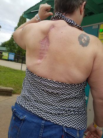 Healed after trapezius flap surgery